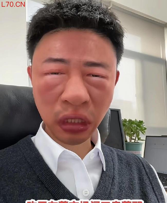 男子误把漆树芽当香椿 吃完脸浮肿